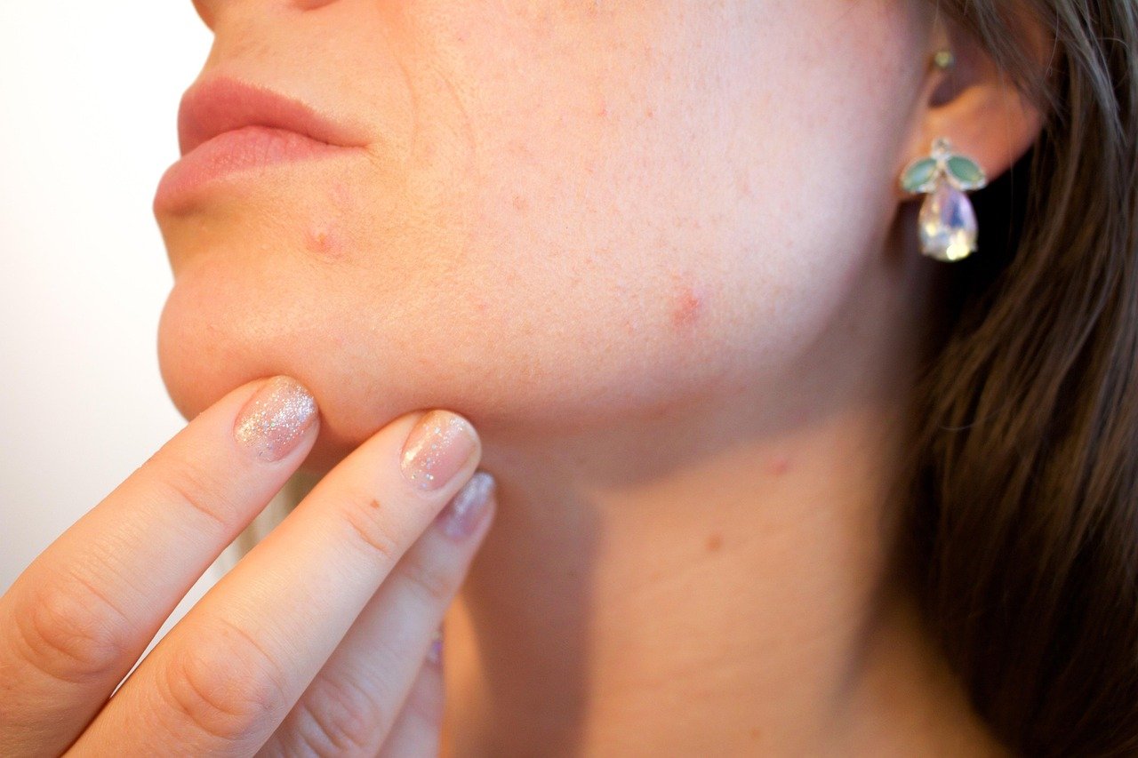 Acne Scar Home Remedies